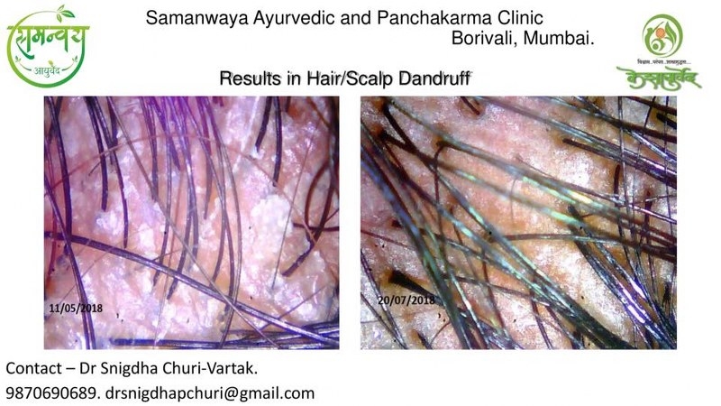  hair Treatment Results @Samanwaya Ayurveda  & Panchakarma Clinic.