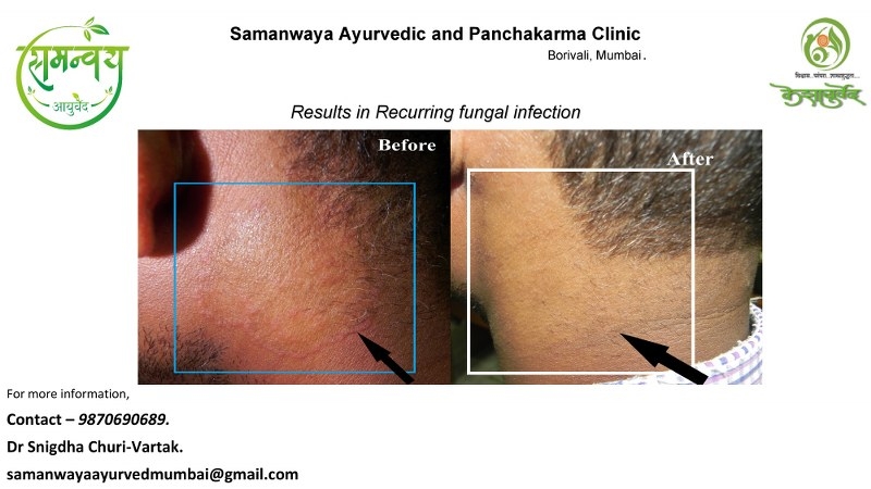 Skin Treatment Results @Samanwaya Ayurveda  & Panchakarma Clinic.